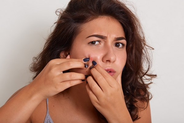 Acne may be a sign of over exfoliated skin.
