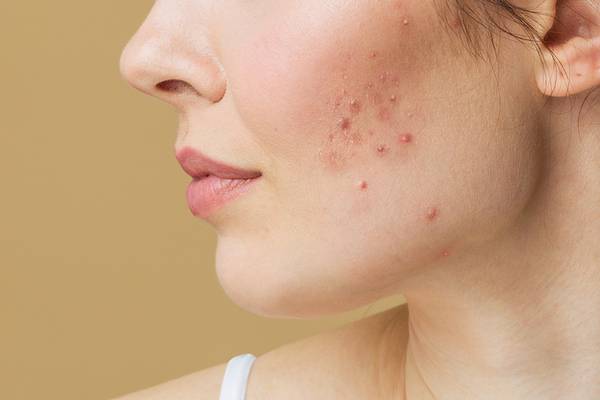 How to Get Rid of Redness from Acne