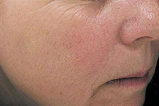 Chemical Peel