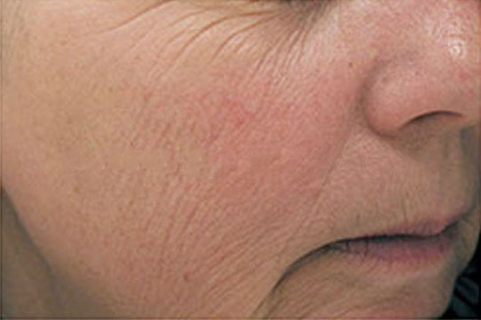 Chemical Peel