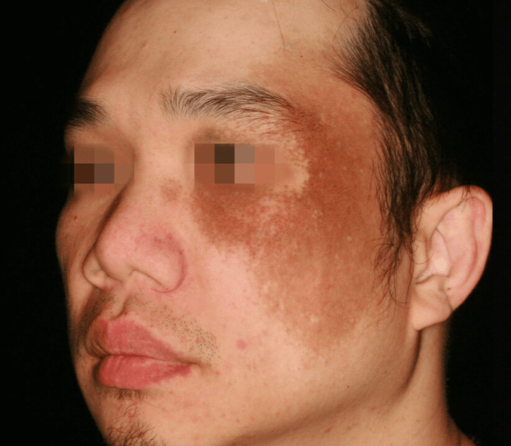 PicoSure Pro Laser Treatments