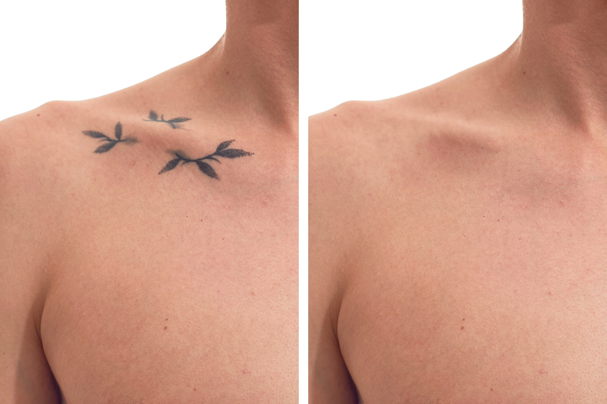 BeautiMed Laser Machines Australia tattoo removal