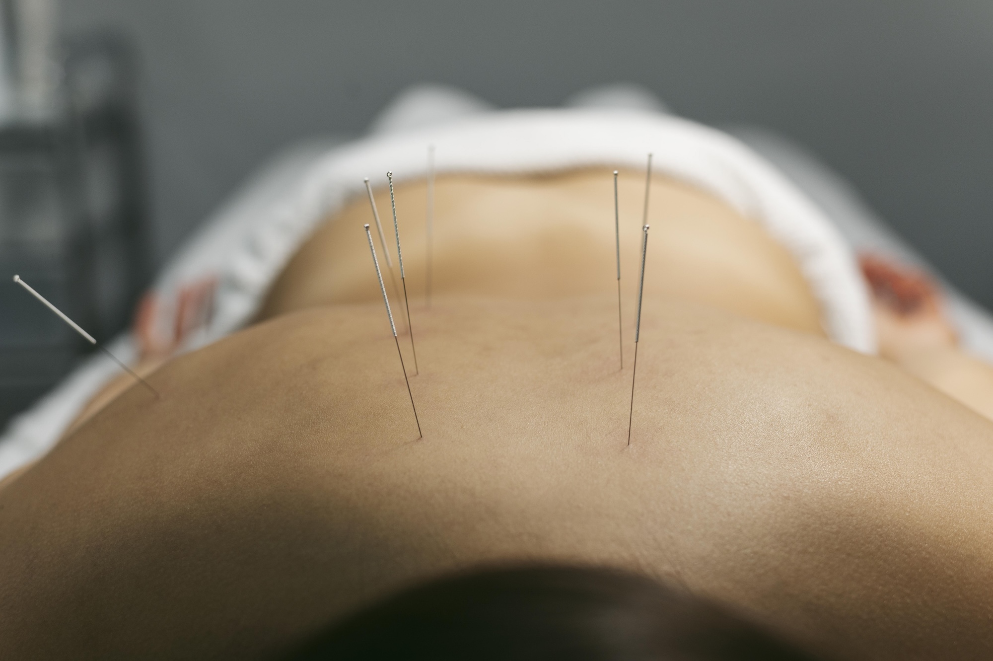 Dry Needling im Wirbelsäulenbereich zur Behandlung muskulärer Verspannungen bei akutem Hexenschuss.