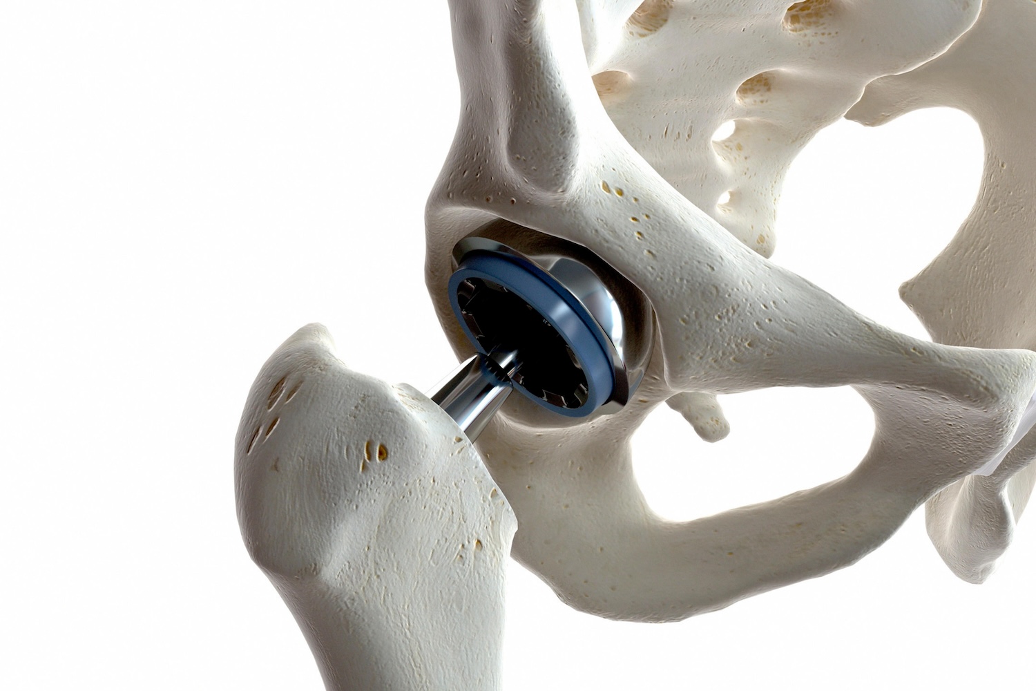 Anatomische Darstellung einer Hüft-TEP mit künstlichem Hüftkopf, Hüftpfanne und Prothesenschaft.