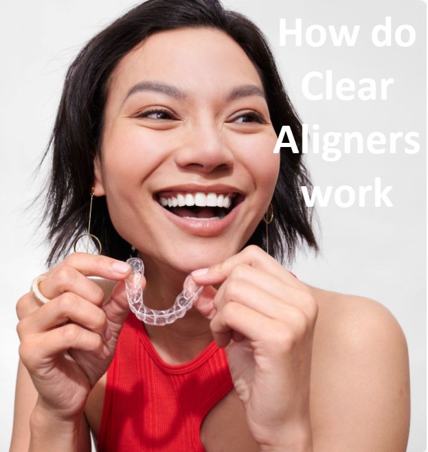 How Do Clear Aligners Work? A Guide to a Straighter Smile