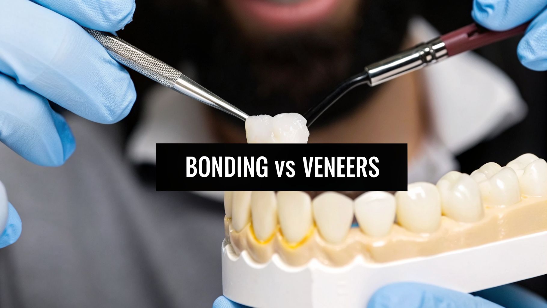 A dental professional's gloved hands demonstrating a bonding or veneer procedure on a tooth model.