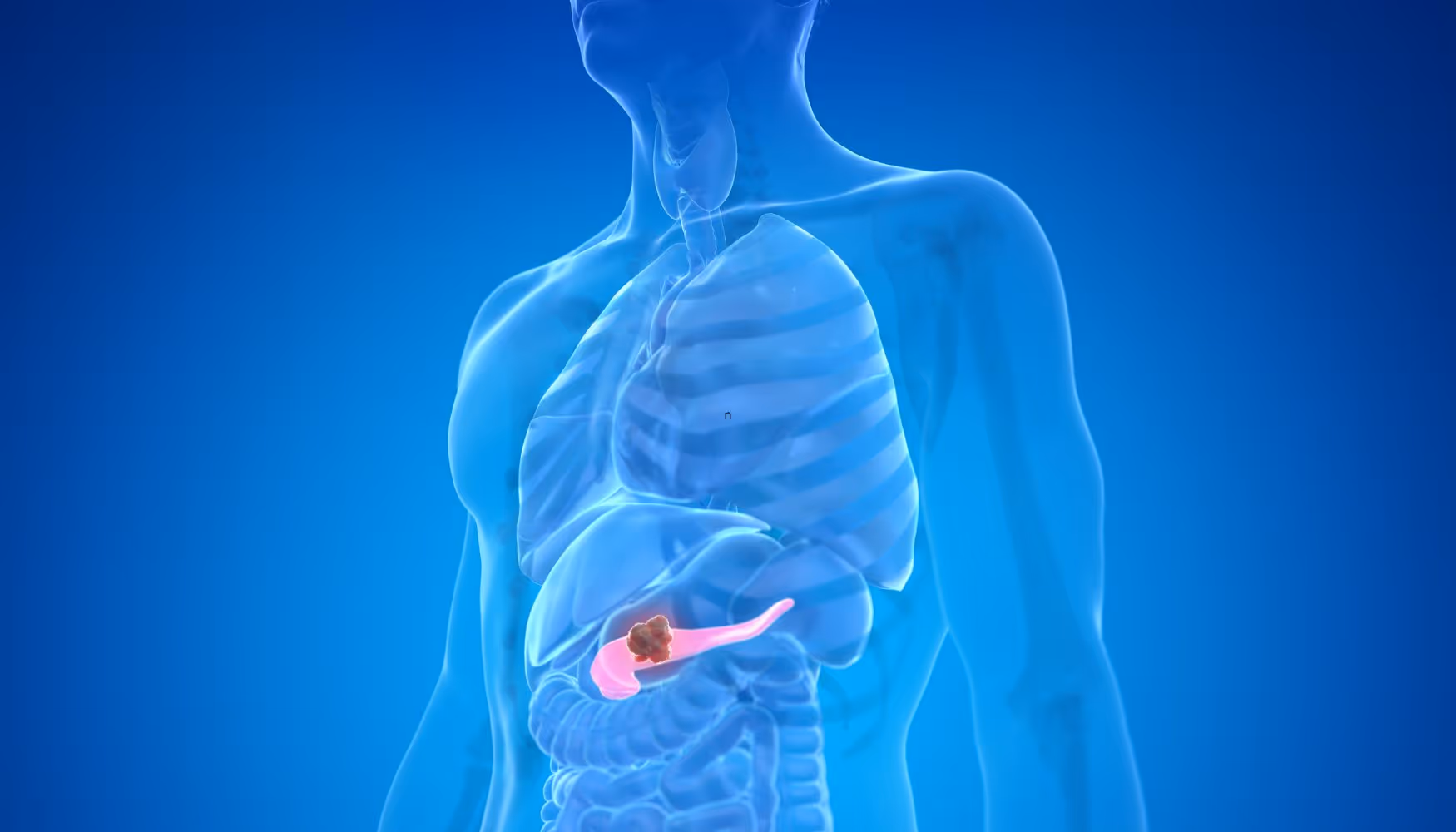 can alcoholism cause pancreatic cancer