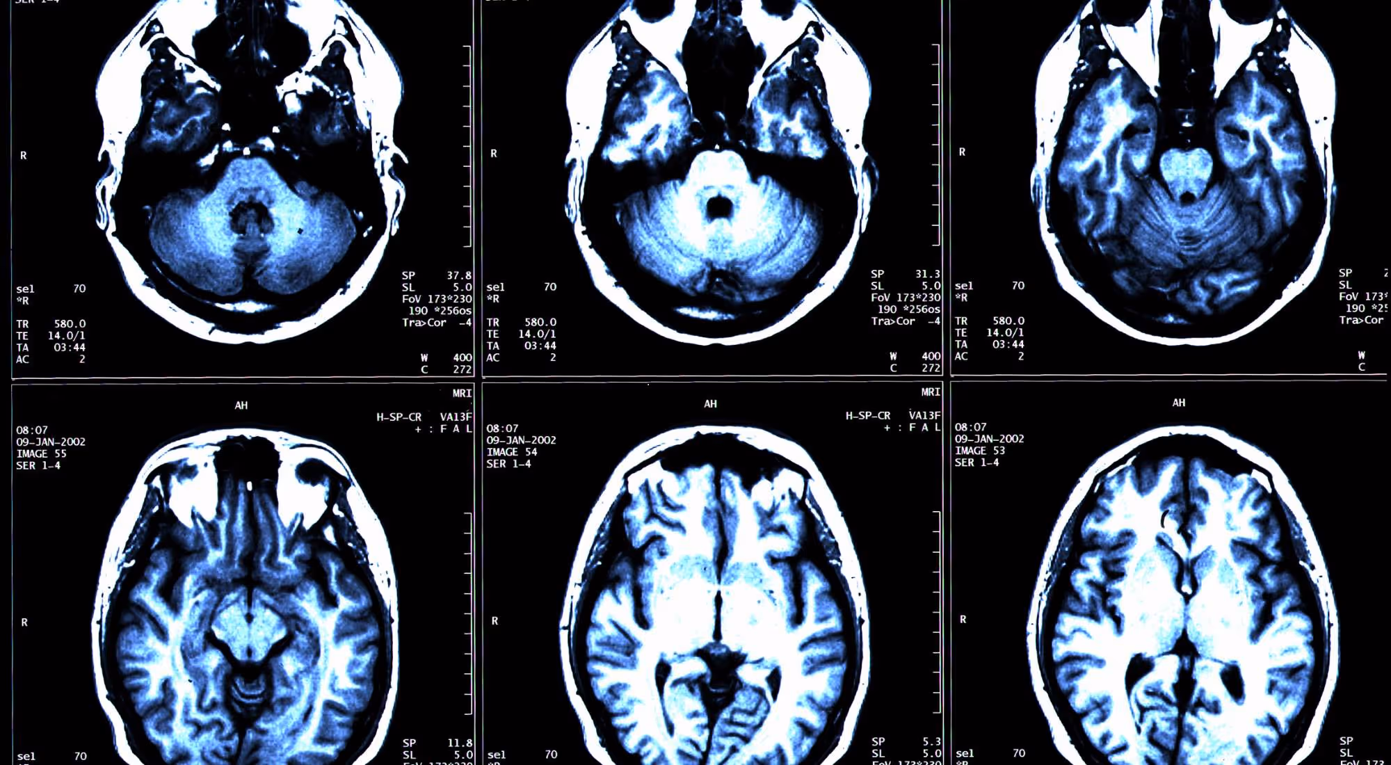 can drinking alcohol cause a stroke