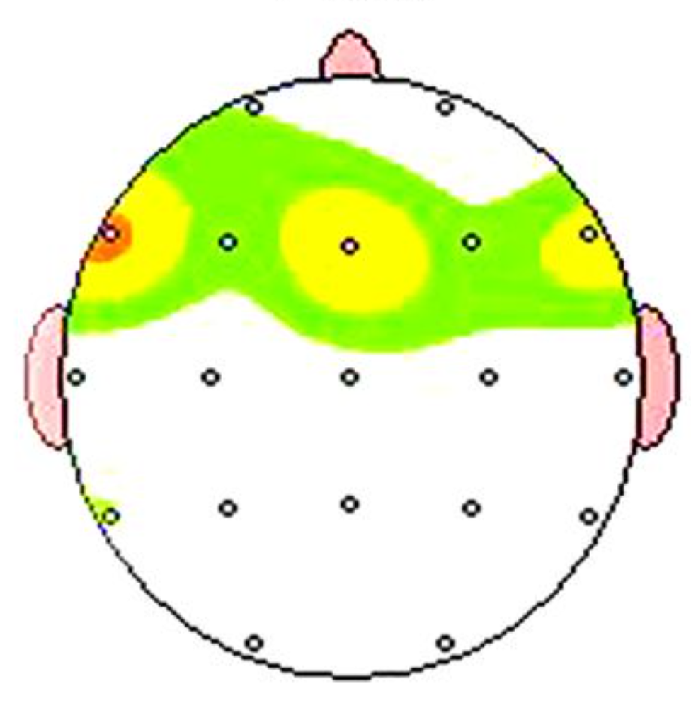 After 40 sessions Brain Map
