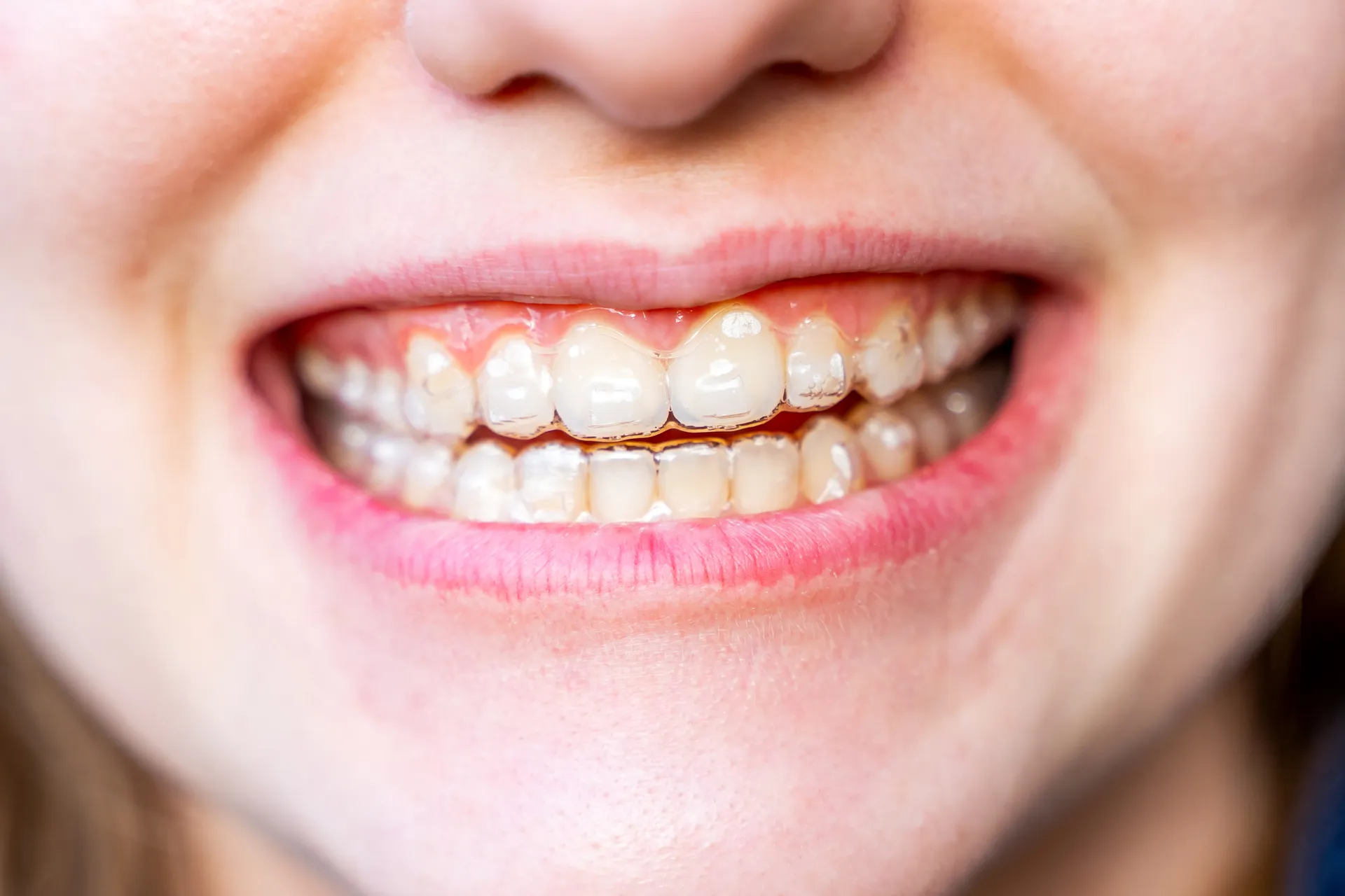 Invisalign for Kids