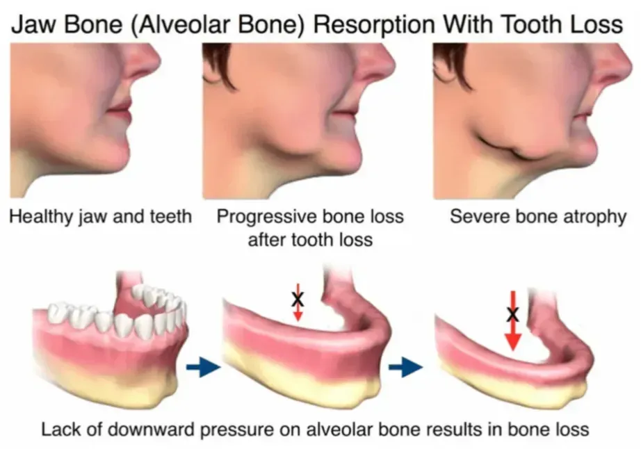 Jaw Bone
