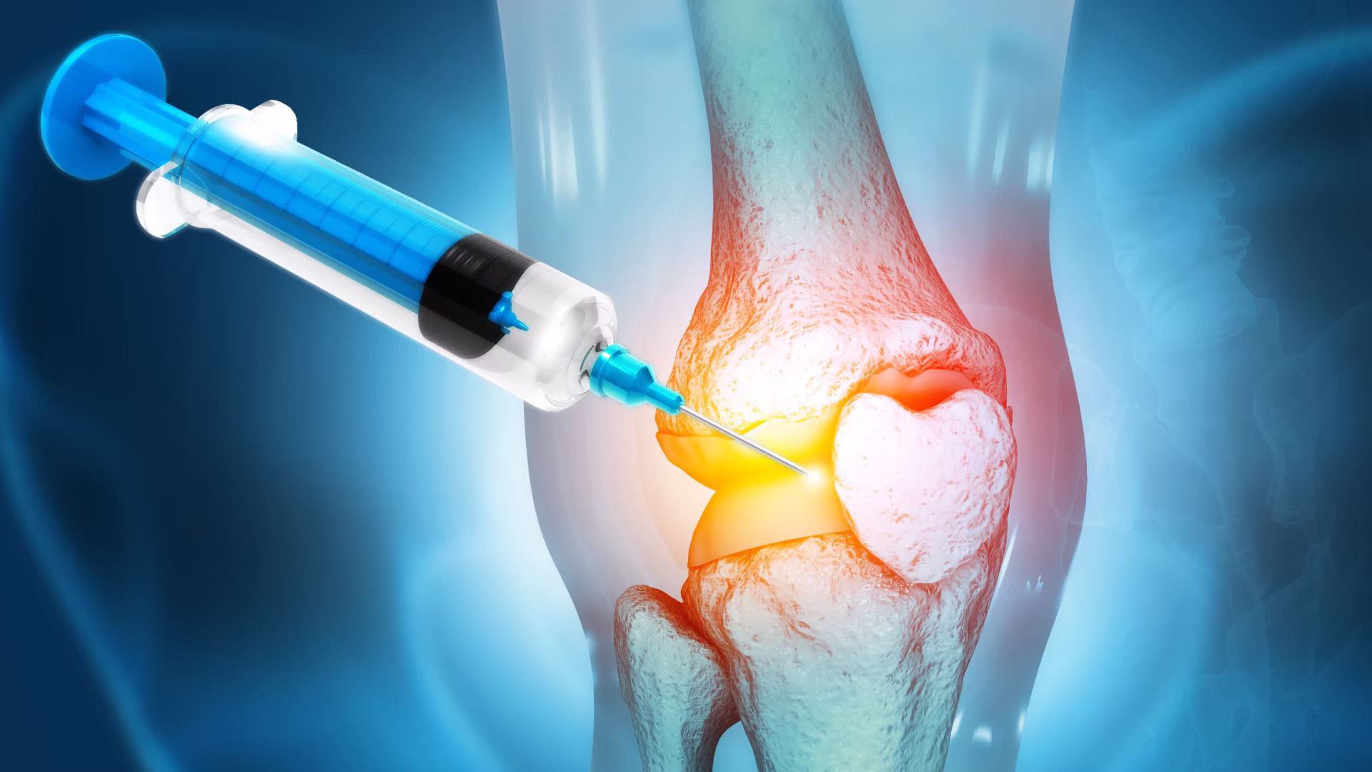 Illustration of a knee injection using orthobiologics like PRP for joint pain and the best regenerative medicine in Marina del Rey, CA.