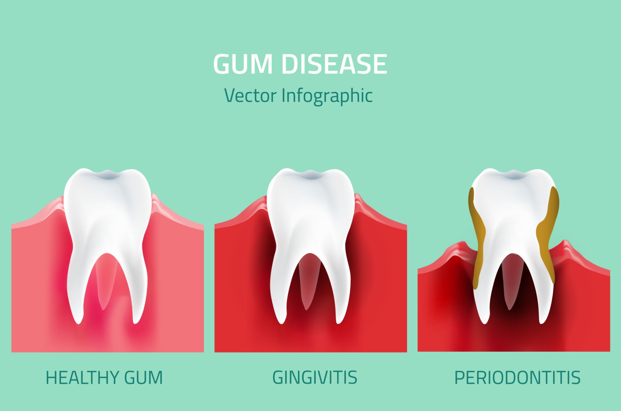 the stages of gum disease, AI generated
