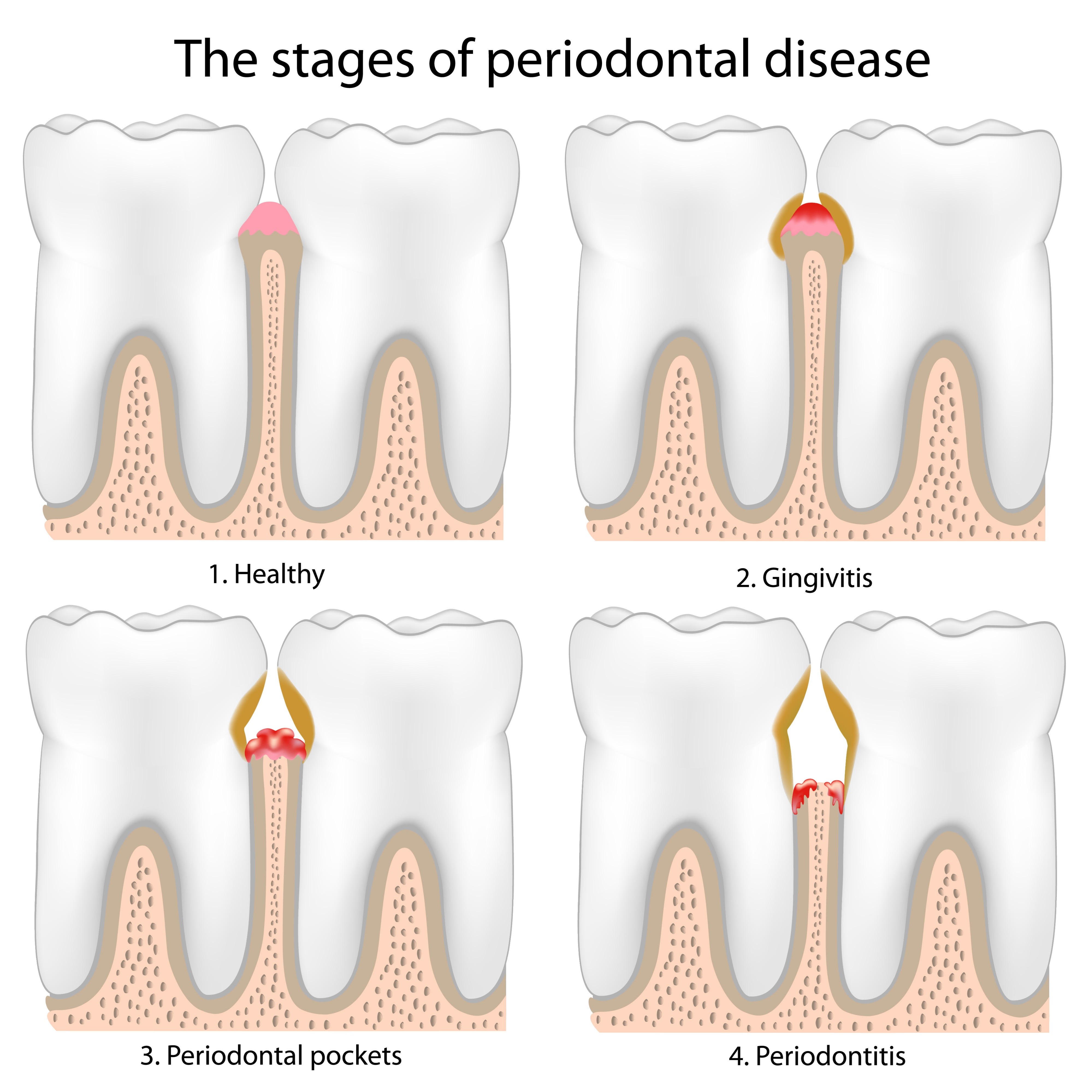stages of periodontal disease, AI generated