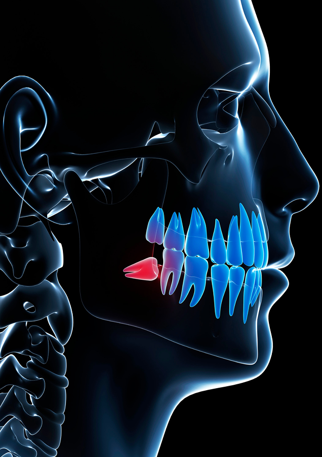 X-ray style side view of a human skull highlighting an impacted lower wisdom tooth in red.