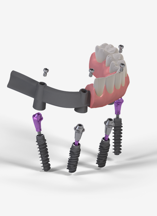 3D illustration of dental implants with abutments and a partial upper jaw prosthesis showing teeth and gums, positioned above a metal framework.