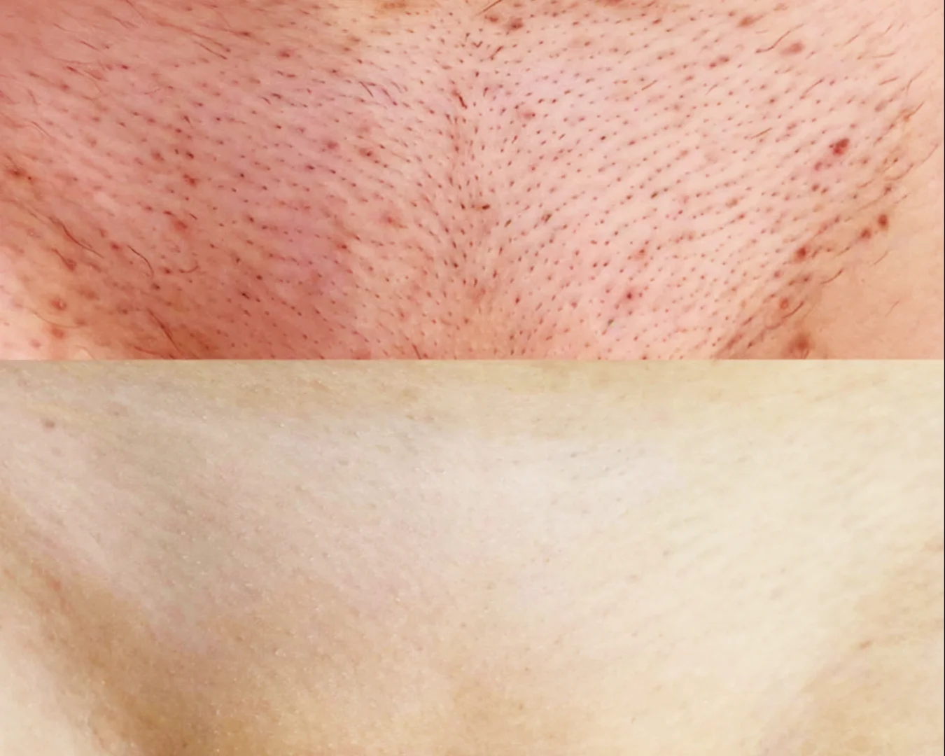 Vergleich vorher und nachher Laser Behandlung Bikini Zone