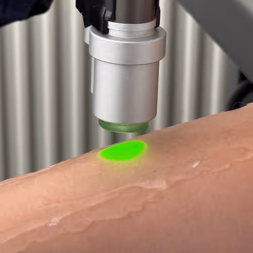 Die Alexandrit Laser Haarentfernung arbeitet mit einem feinen grünen Lichtstrahl, der gezielt in die Haarwurzel eindringt.