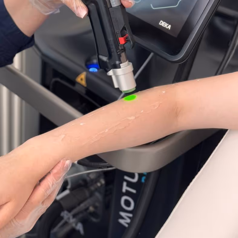 Nahaufnahme eines Alexandrit-Lasergeräts, das während einer Hautbehandlung grünes Licht auf den Unterarm einer Person aussendet.