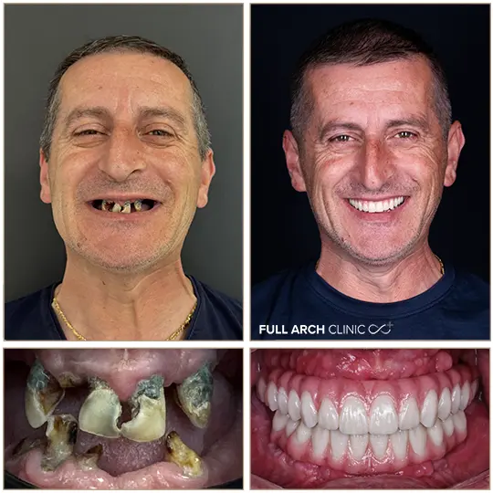 Implanturi dentare before-after pacient 12 implanturi dentare