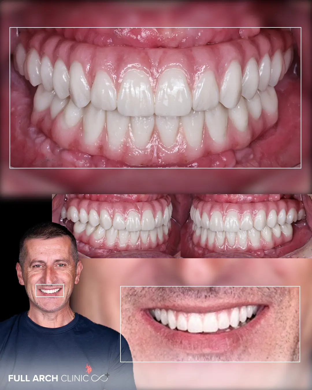 lucrare allon6 din ceramica stratificata pe zirconiu