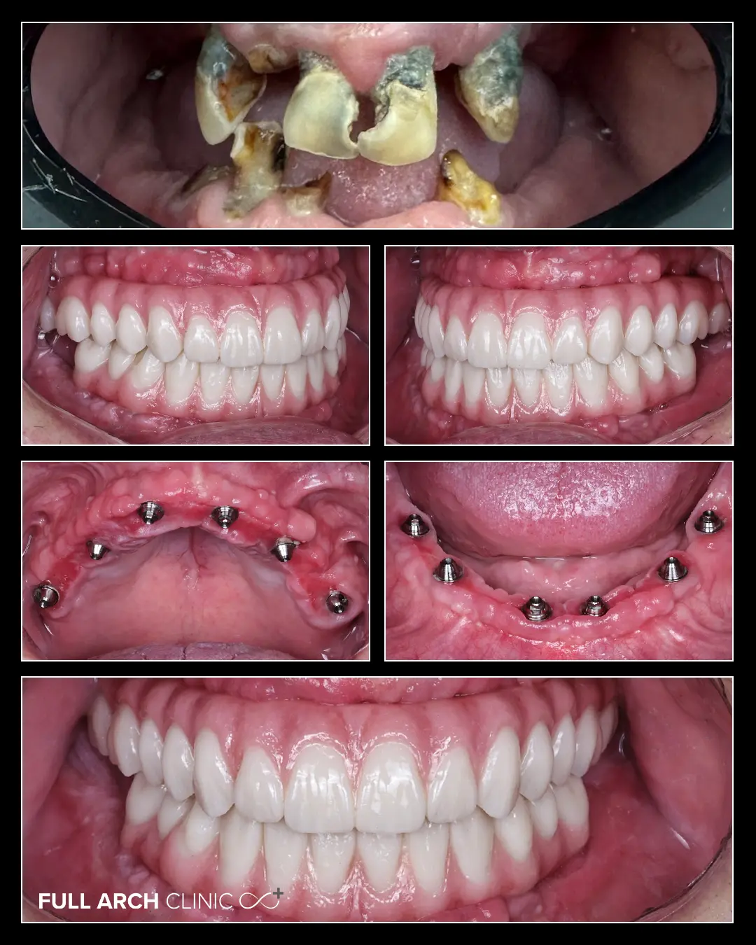 Imagini Intraorale Lucrari Zirconiu cu Ceramica Stratificata