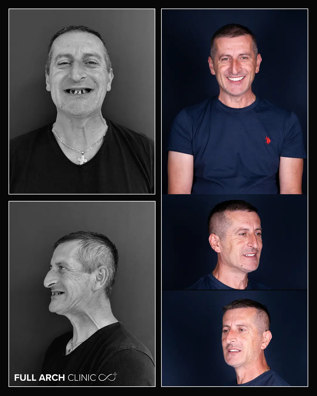 before after pacient 12 implanturi dentare, dinti ficsi bimaxilar