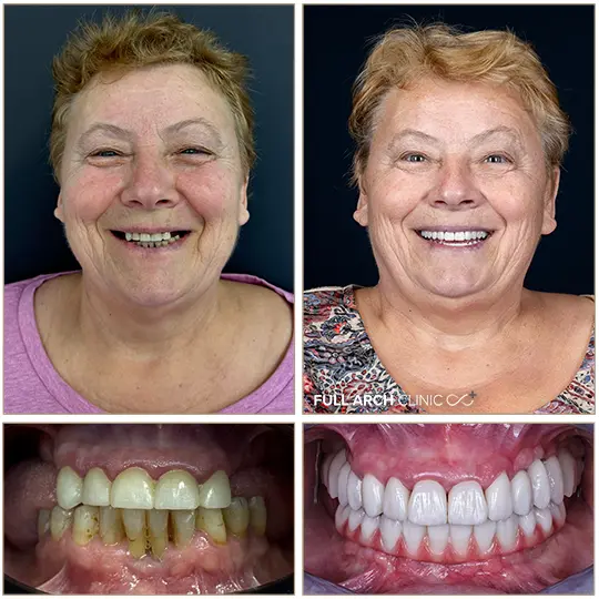 poza before after tratament pe 10 implanturi si coroane zirconiu pe dintii