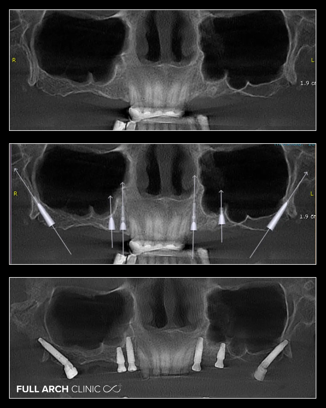 sectiune din CBCT 6 implanturi, before, planificare, after
