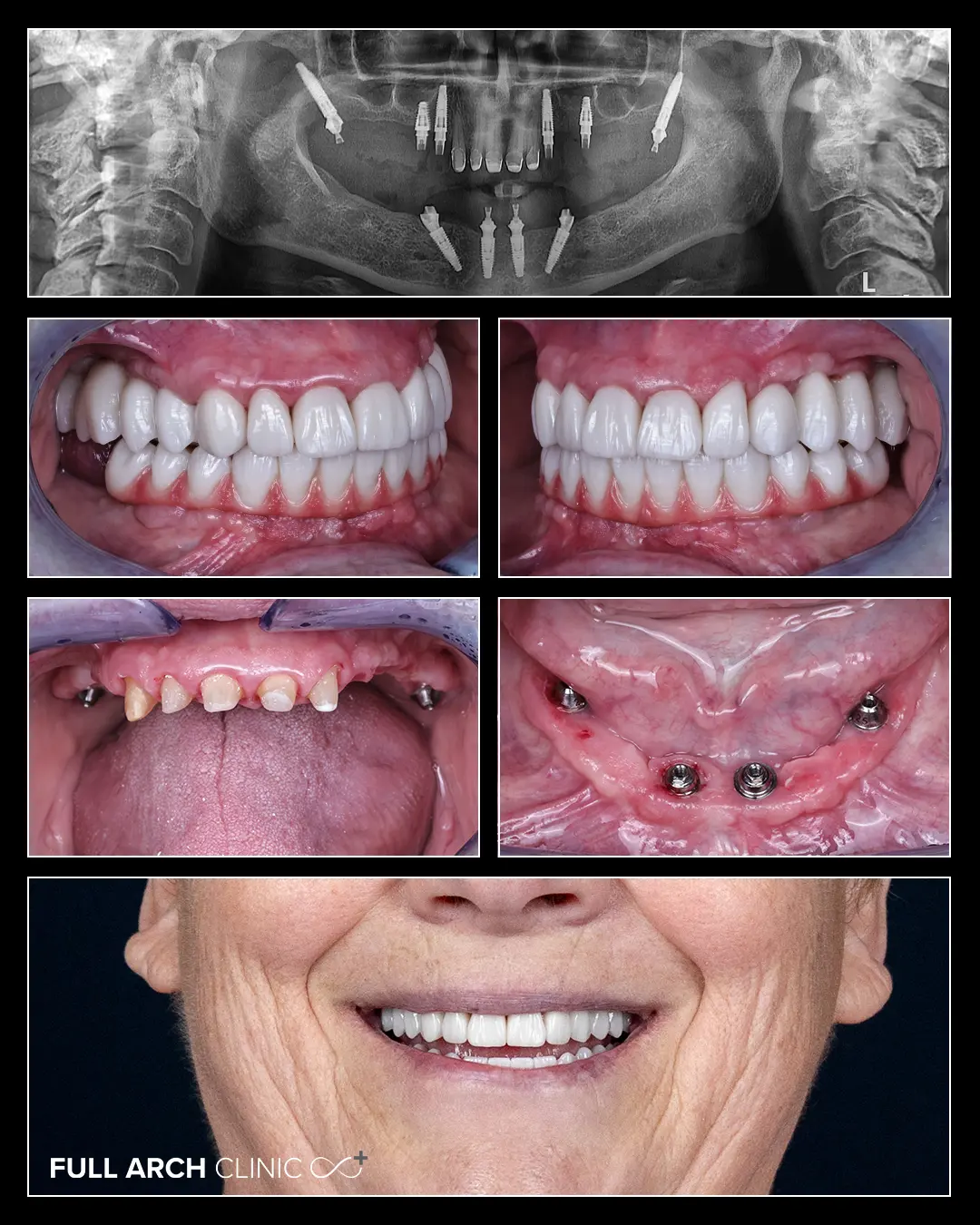10 implanturi si 5 coroane zirconiu radiografie after, slefuiri si vindecare