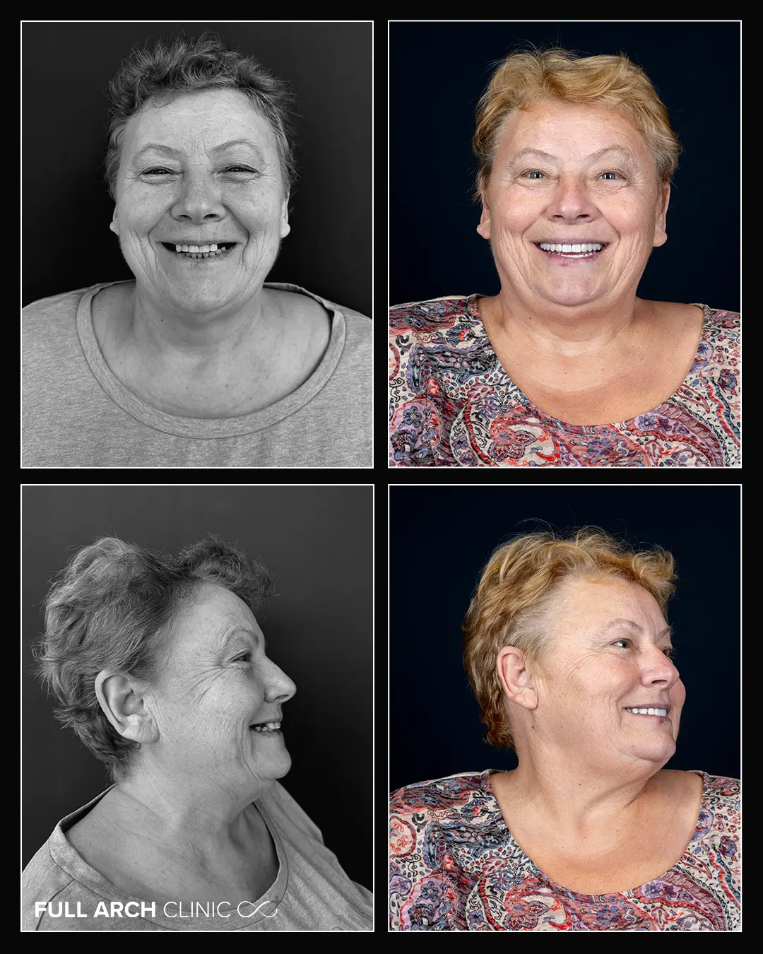 imagini before after tratament cu 10 implanturi profil si frontal