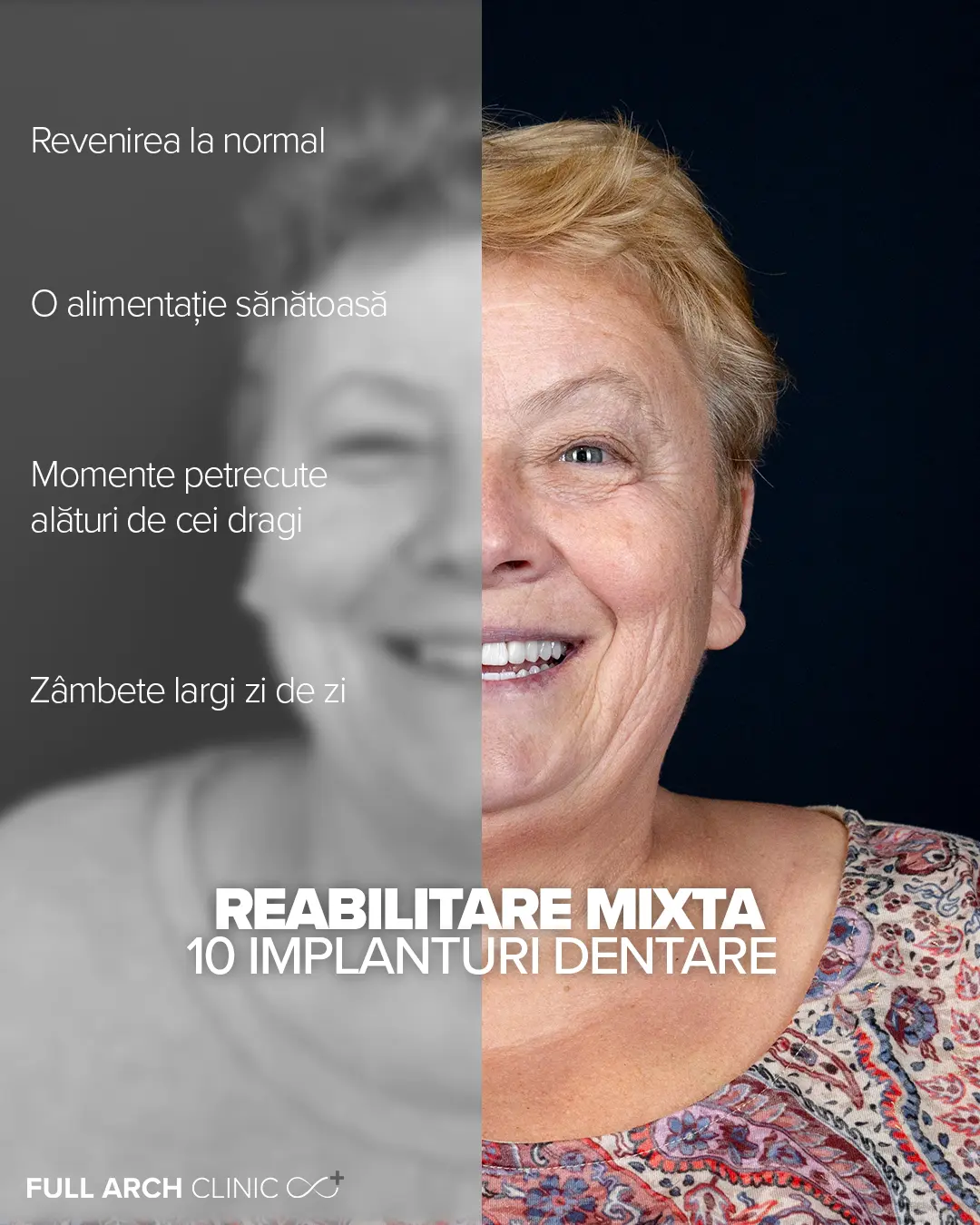 beneficii tratament stomatologic cu implanturi si coroane