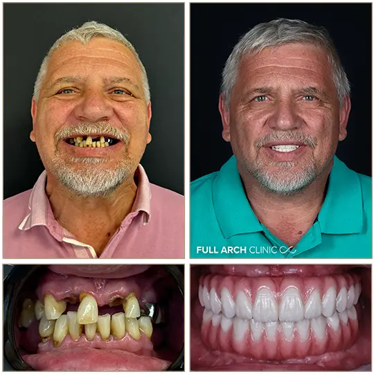 before and after pacient cu parodontoza avansata si dinti ficsi 12 implanturi