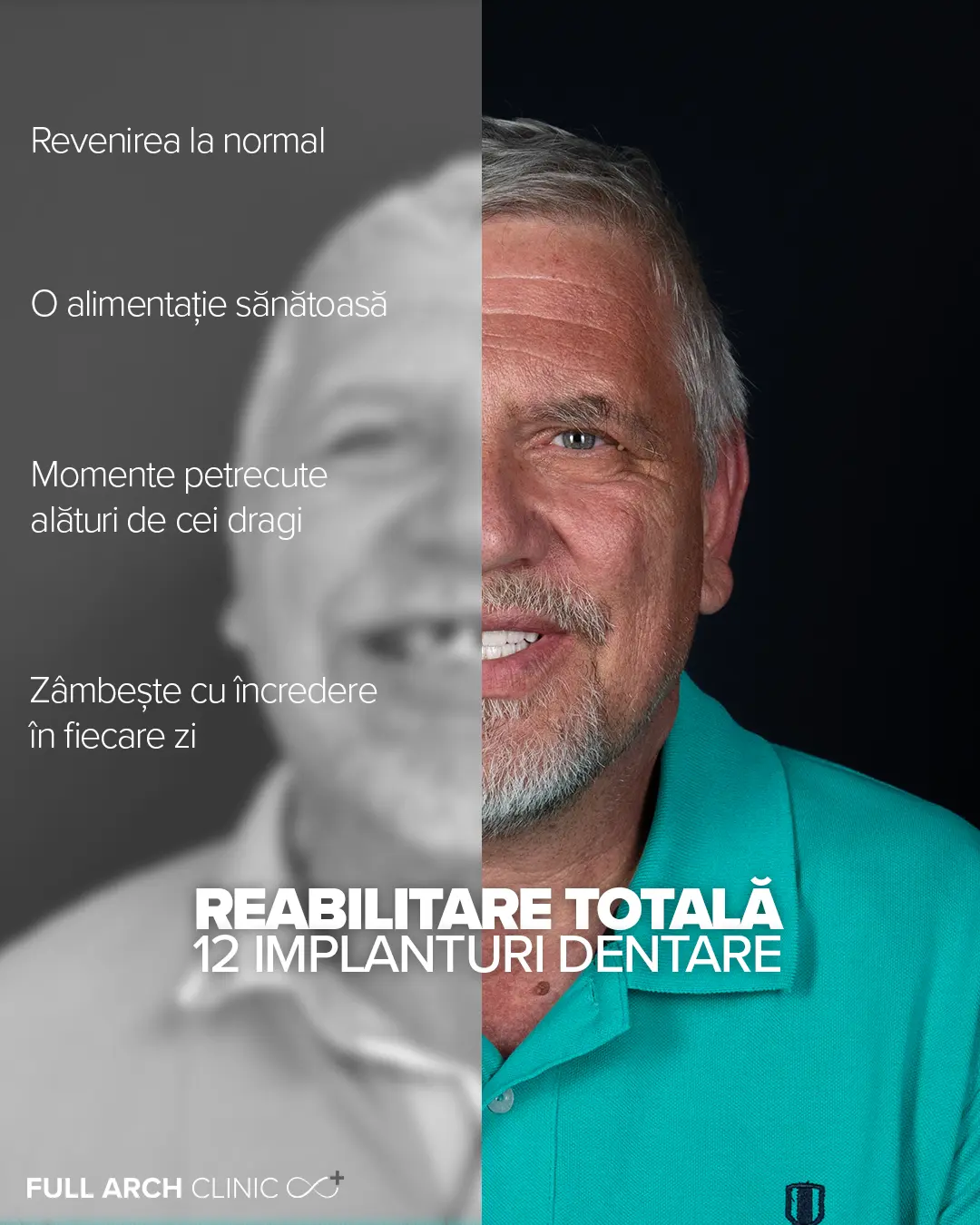 avantajale tratamentului cu implanturi allon6 maxilar si mandibula