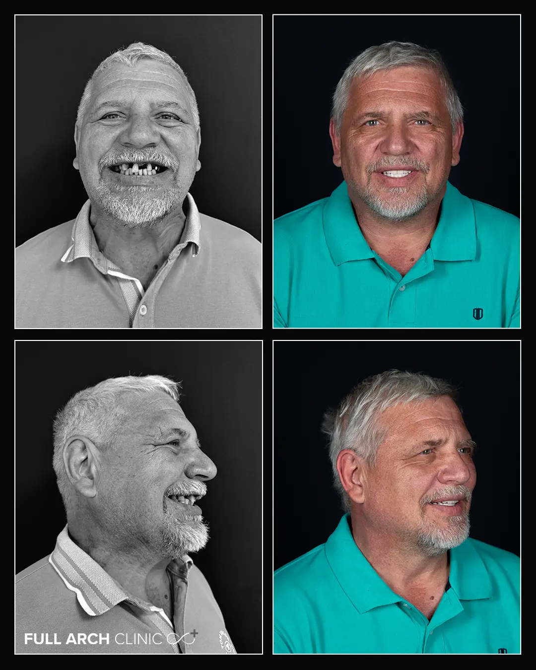 before after frontal si din lateral la pacient cu allon6 maxilar si mandibula