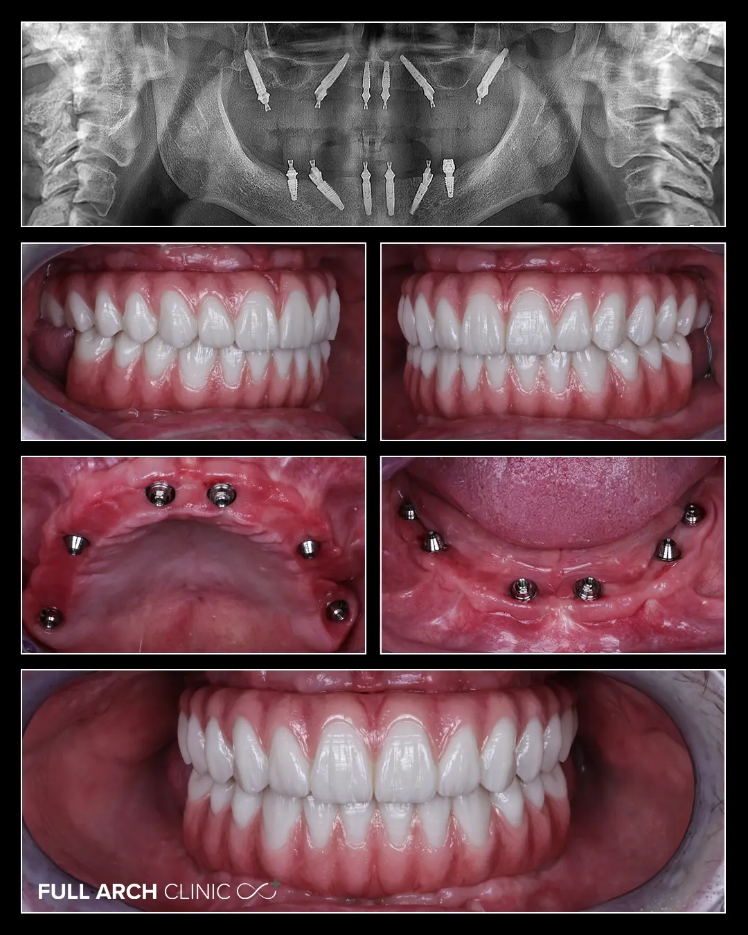 radiografie si imagini intraorale cu lucrari de zirconiu pe bara de titan pe implant
