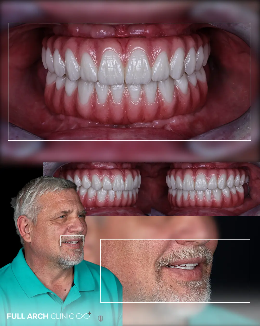 pacient din profil si poza intraorala cu lucrarile din ceramica stratificata pe zirconiu