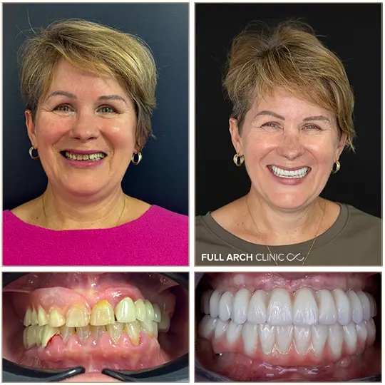 caz dinti ficsi pe 6 implanturi dentare maxilar si 6 mandibula before after fata si dinti