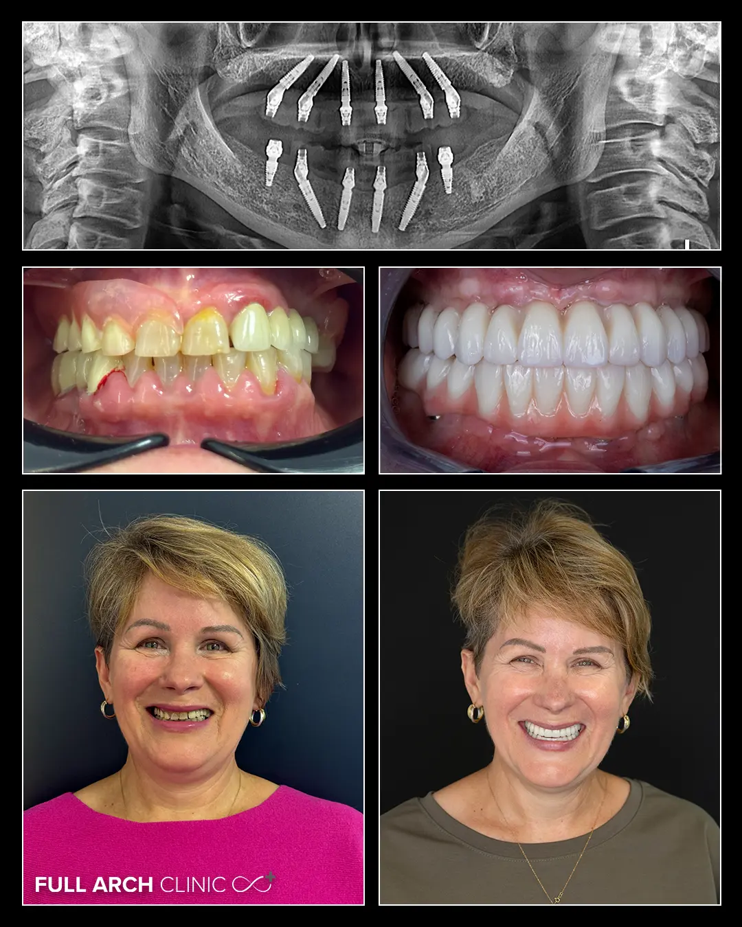 imagini before after cu fata si cu dantura si radiografie cu 12 implanturi