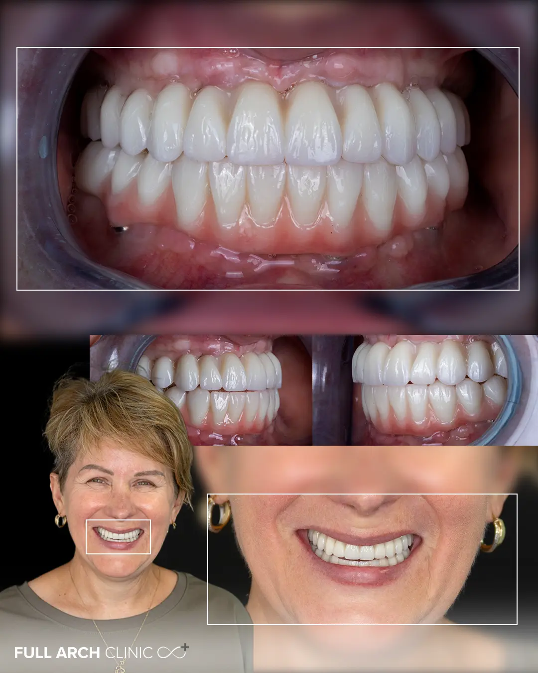 imagini intraorale cu 2 lucrari din zirconiu pe 6 implanturi dentare