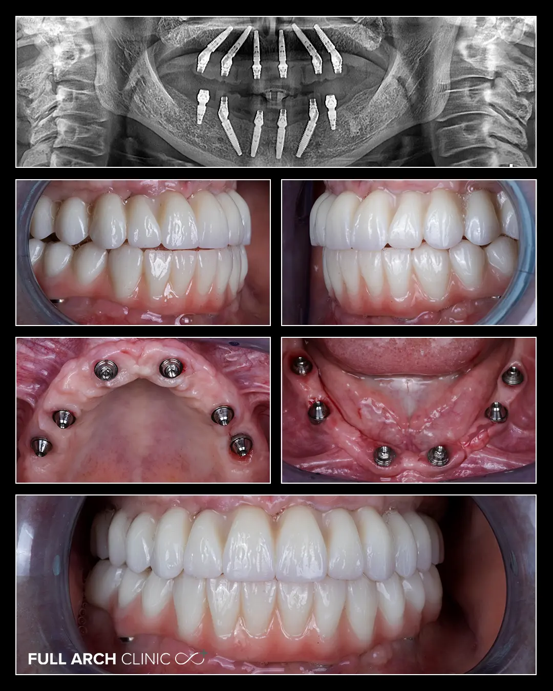 imagini intraorale cu vindecarea la 18 luni de la interventia cu implanturi