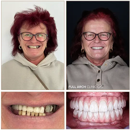 Transformare completă: zâmbet nou, natural și stabil.