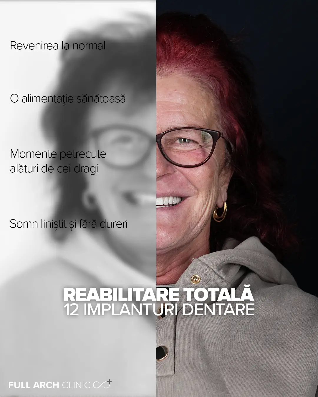 Zâmbet complet transformat prin reabilitare pe 12 implanturi.
