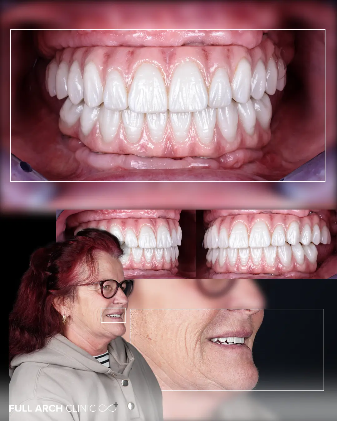 Estetică finală naturală după reabilitare completă pe implanturi.