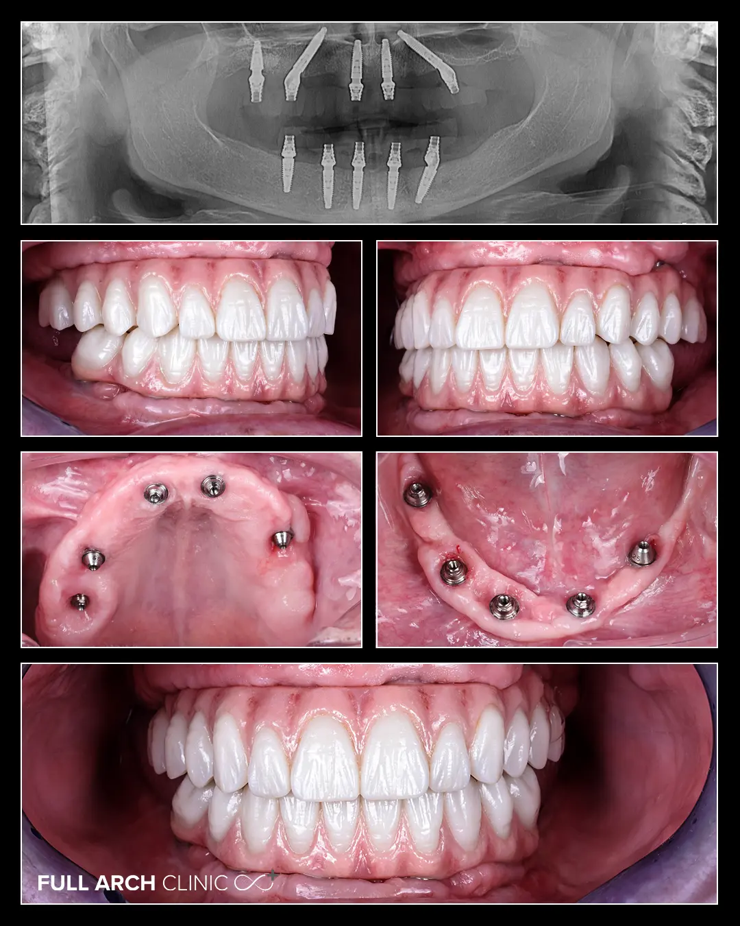 Etapele tratamentului: implanturi, vindecare și lucrare finală.