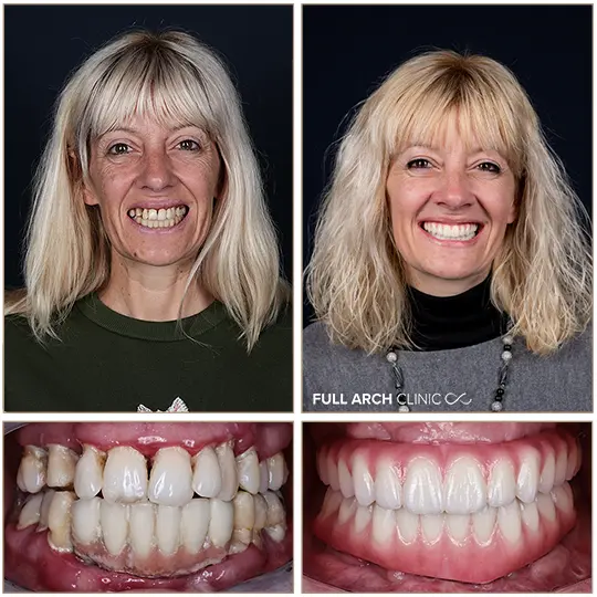 Before/after: dantură fixă din zirconiu pe implanturi — doamna Cibu, Full Arch Clinic