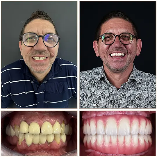 Dantură fixă pe 9 implanturi dentare — cazul domnului Grigoraș, Full Arch Clinic Cluj-Napoca