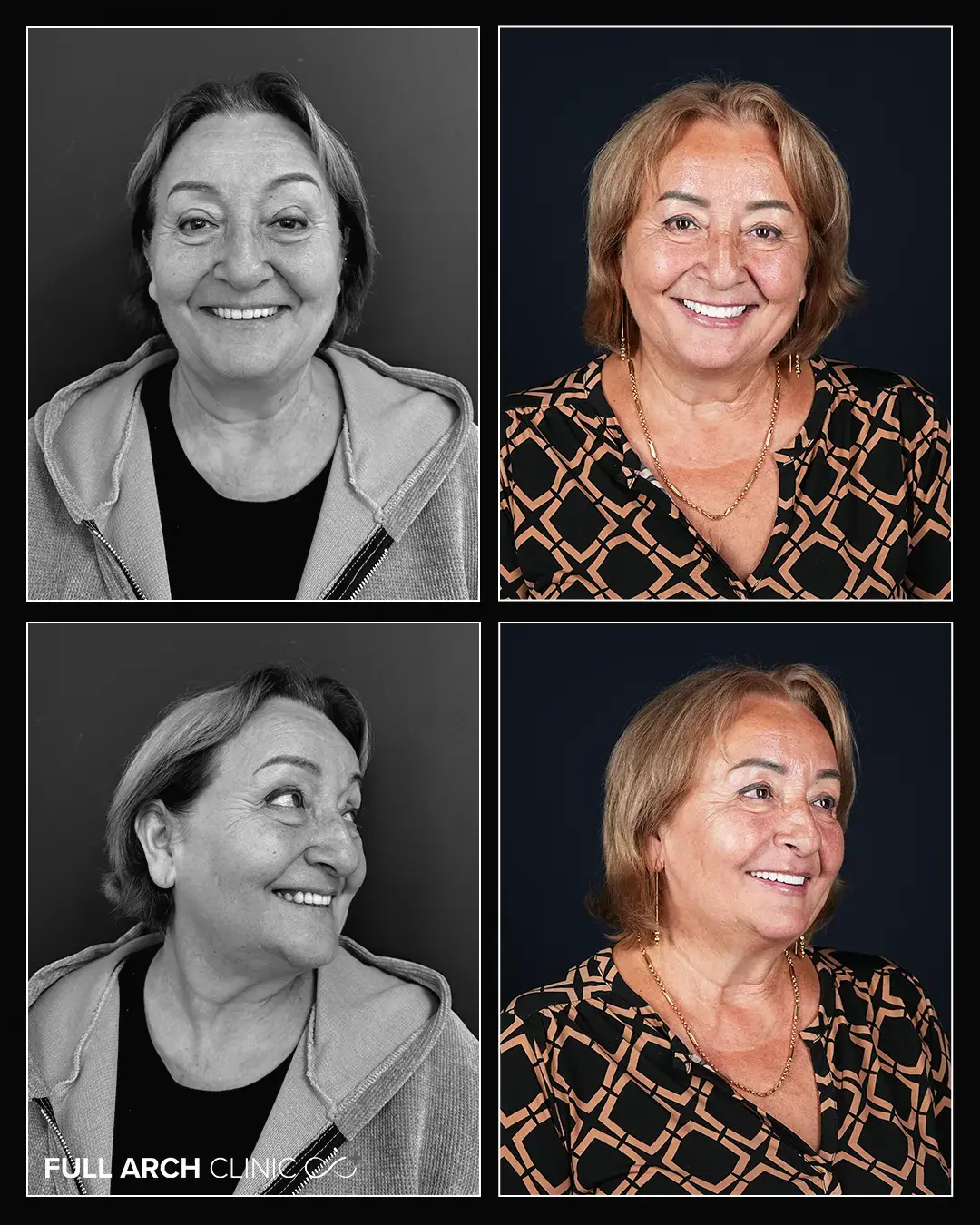 poze frontale si din profile inainte si dupa tratamentul cu implanturi dentare la pacienta din arad
