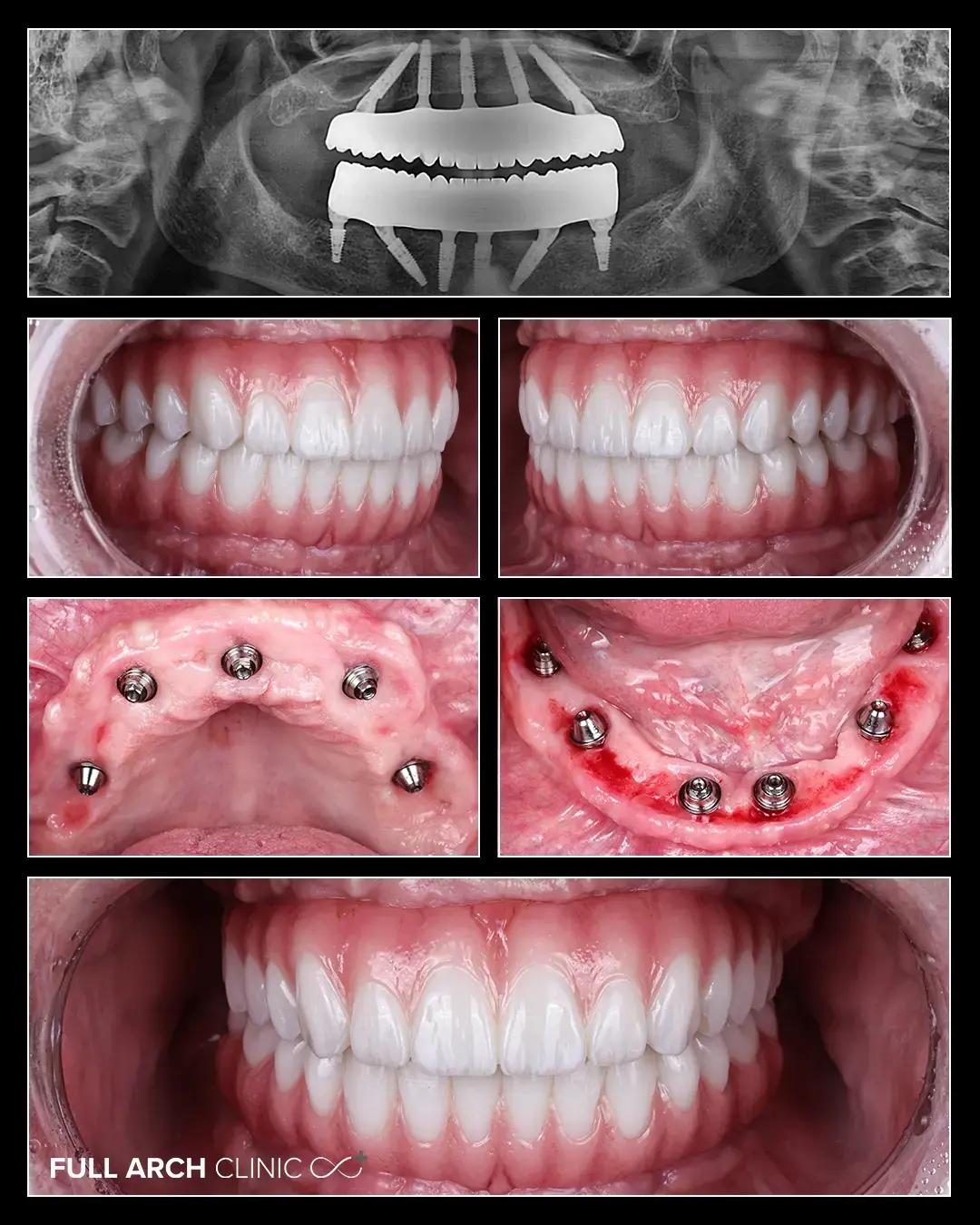 imagini intraorale cu lucrari de zirconiu, vindecarea gingiei la 6 luni de la inceperea tratamentului si radiografia de control 