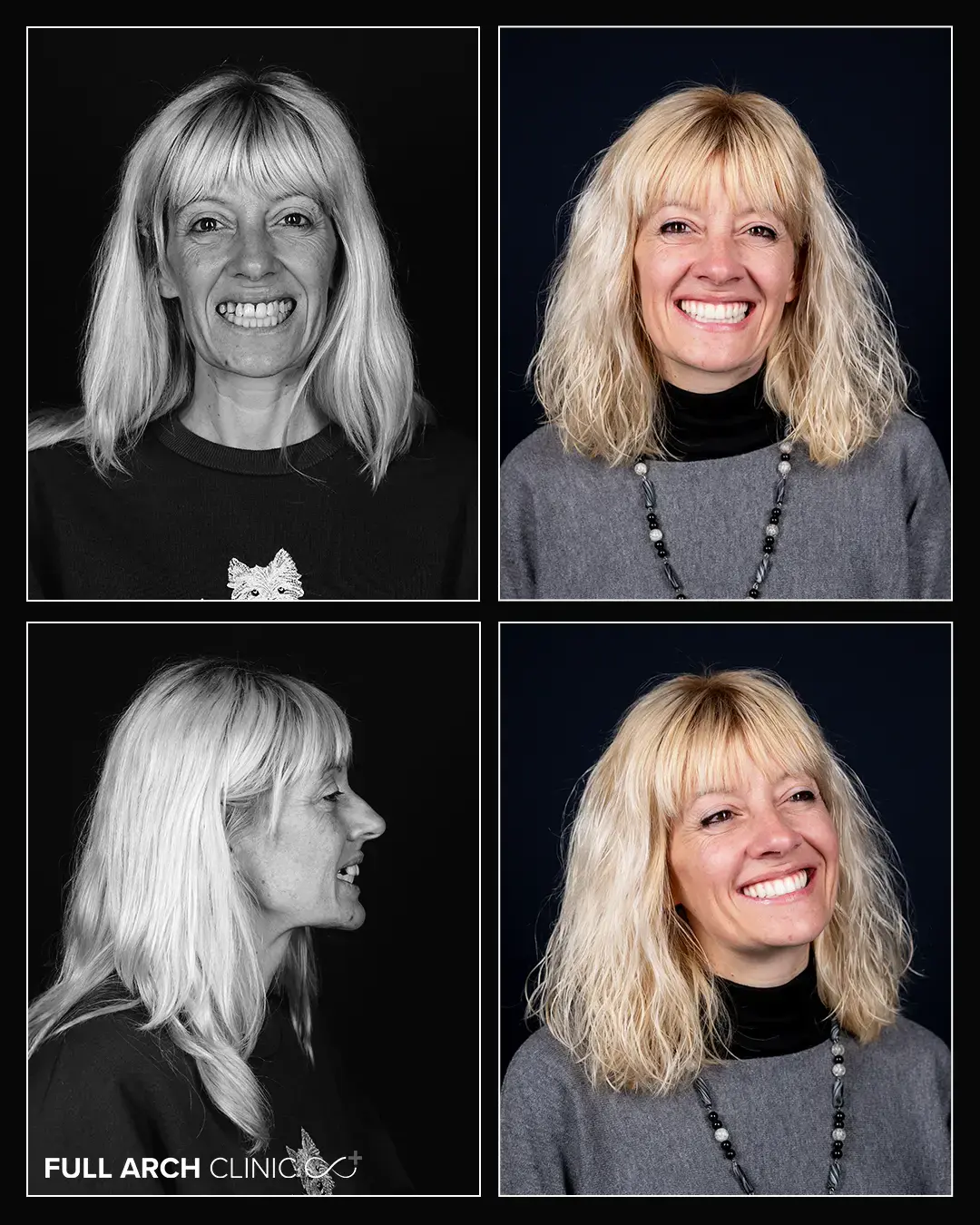 Before/after cu lucrarea finală din zirconiu — reabilitare pe 11 implanturi, doamna Cibu